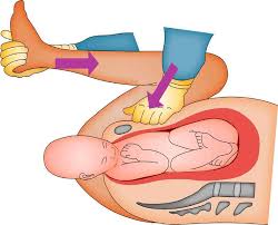 OPTATIVA II: PARTO DISTOCICO
